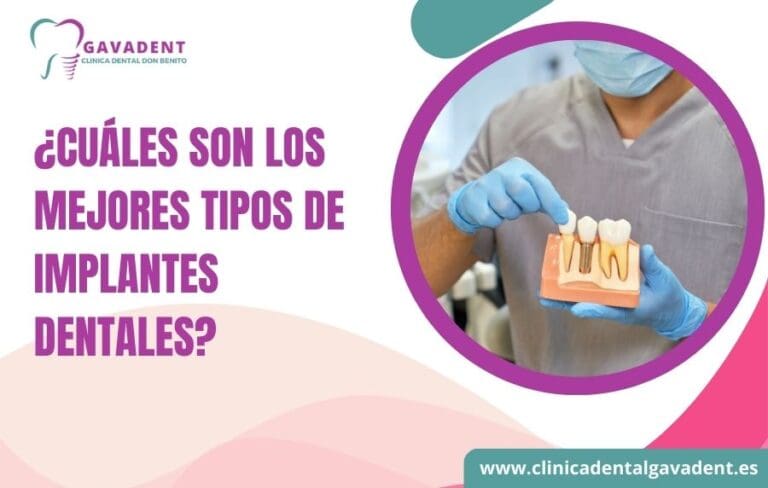 tipos de implantes dentales